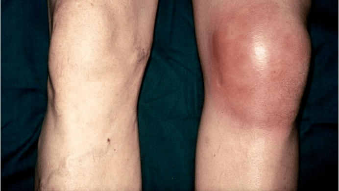 Arthrosis and arthritis